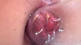 Light suction of rectum with piercing